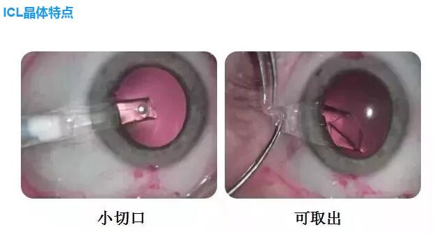 ICLֲձӦʹ ӵµùģԽձ ͨ׽֮Ĥ ĸ߶ȽICLֲֵĵط2.jpg