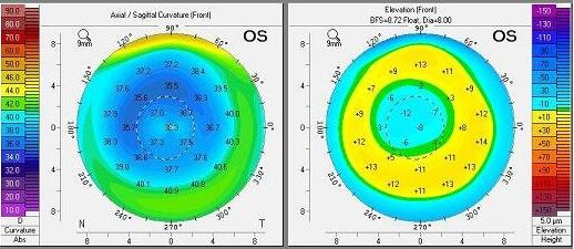 Ű׼ӼĤҽιΪӡԶӡɢⲻҪƾ֤ڹŰ׼ӼĤ׼ӼԽĤ(PRK)ΪĽĤԼ׼ӼԭλĤĥ(LASIK)ΪĽĤ.jpg