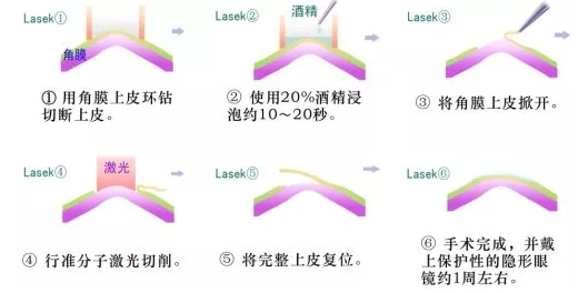 LASEKժ.png